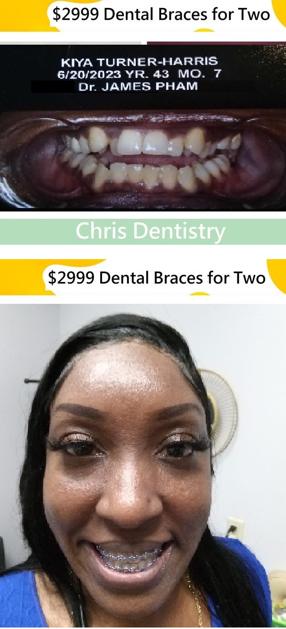 Houston Orthodontics Before and After
