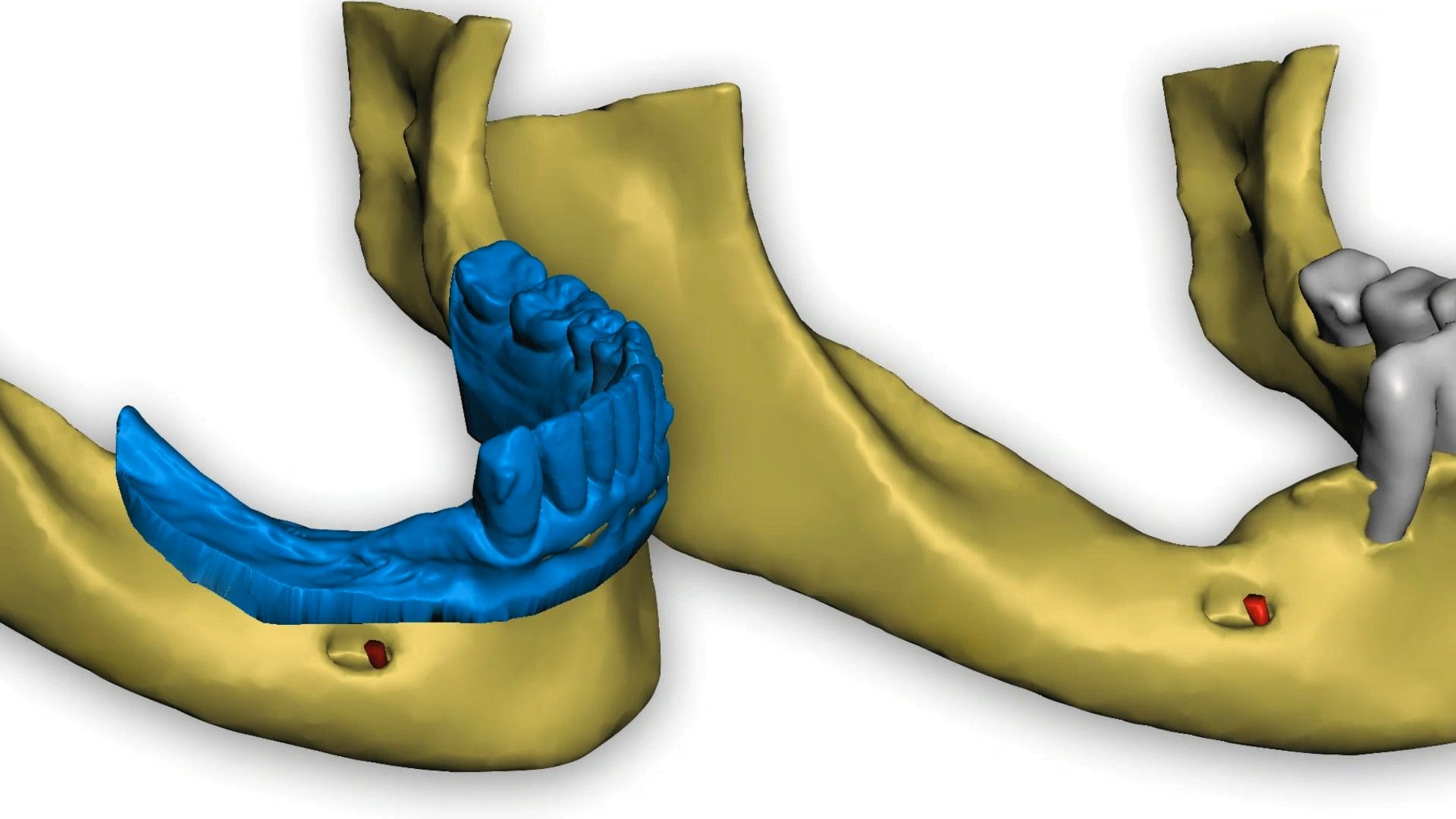 Dental Implant Cinco Ranch