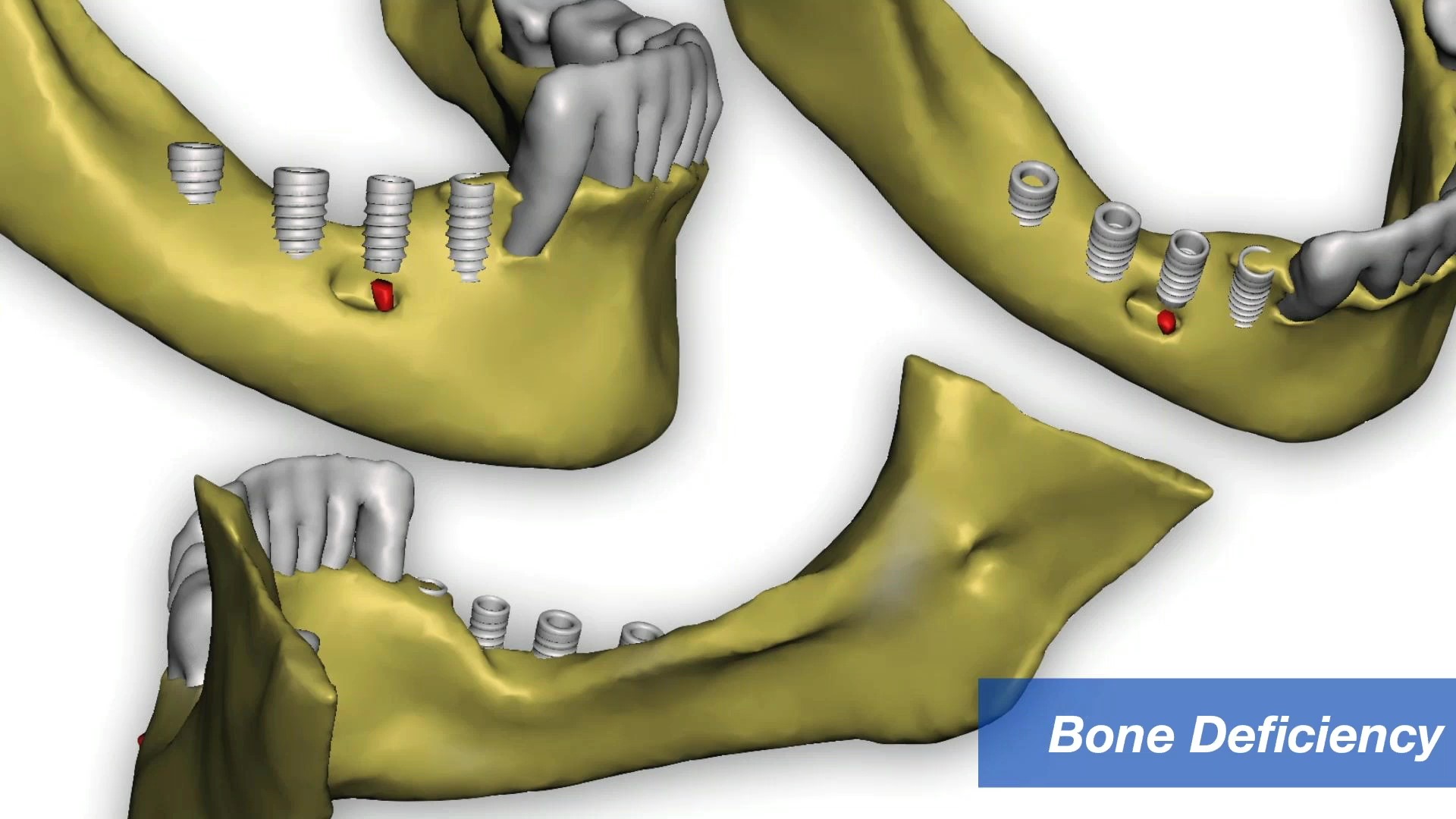 Dental Implant Cinco Ranch