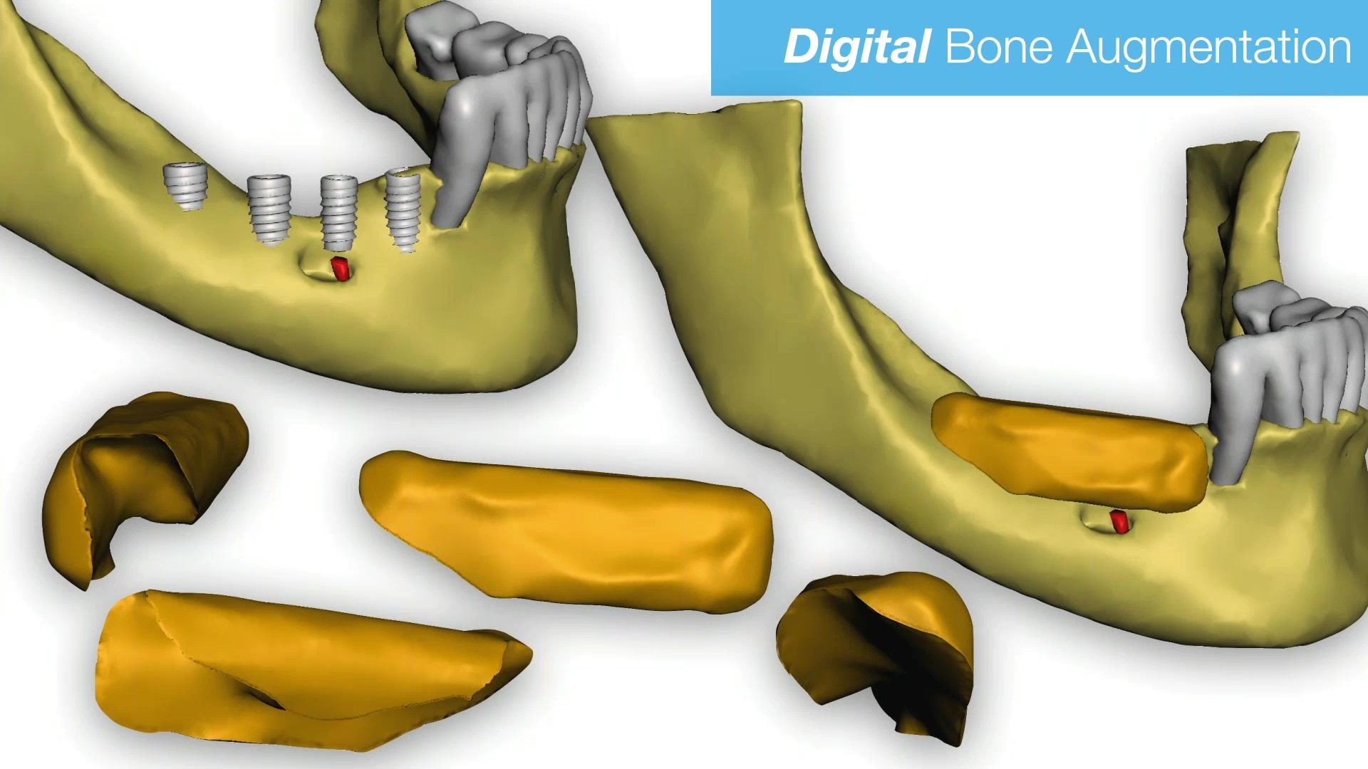 Dental Implant Cinco Ranch