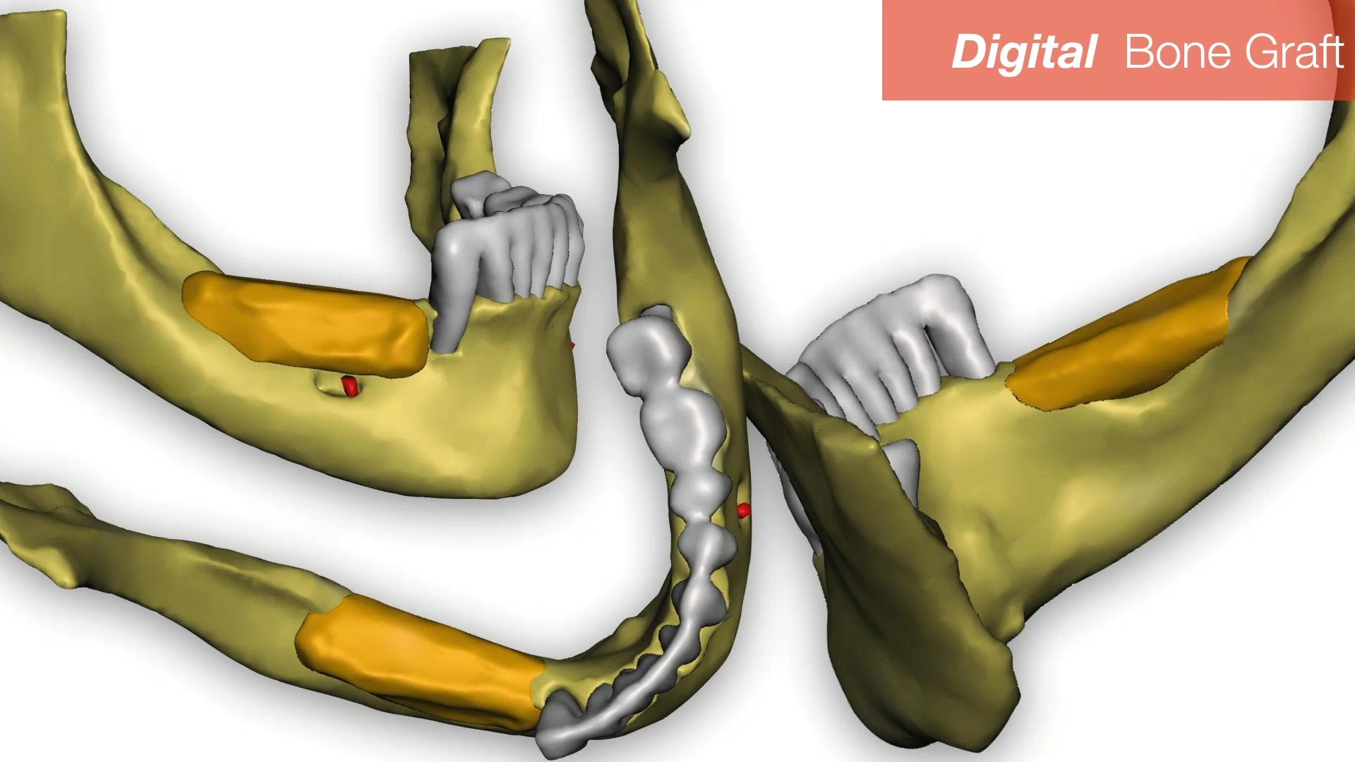 Dental Implant Cinco Ranch