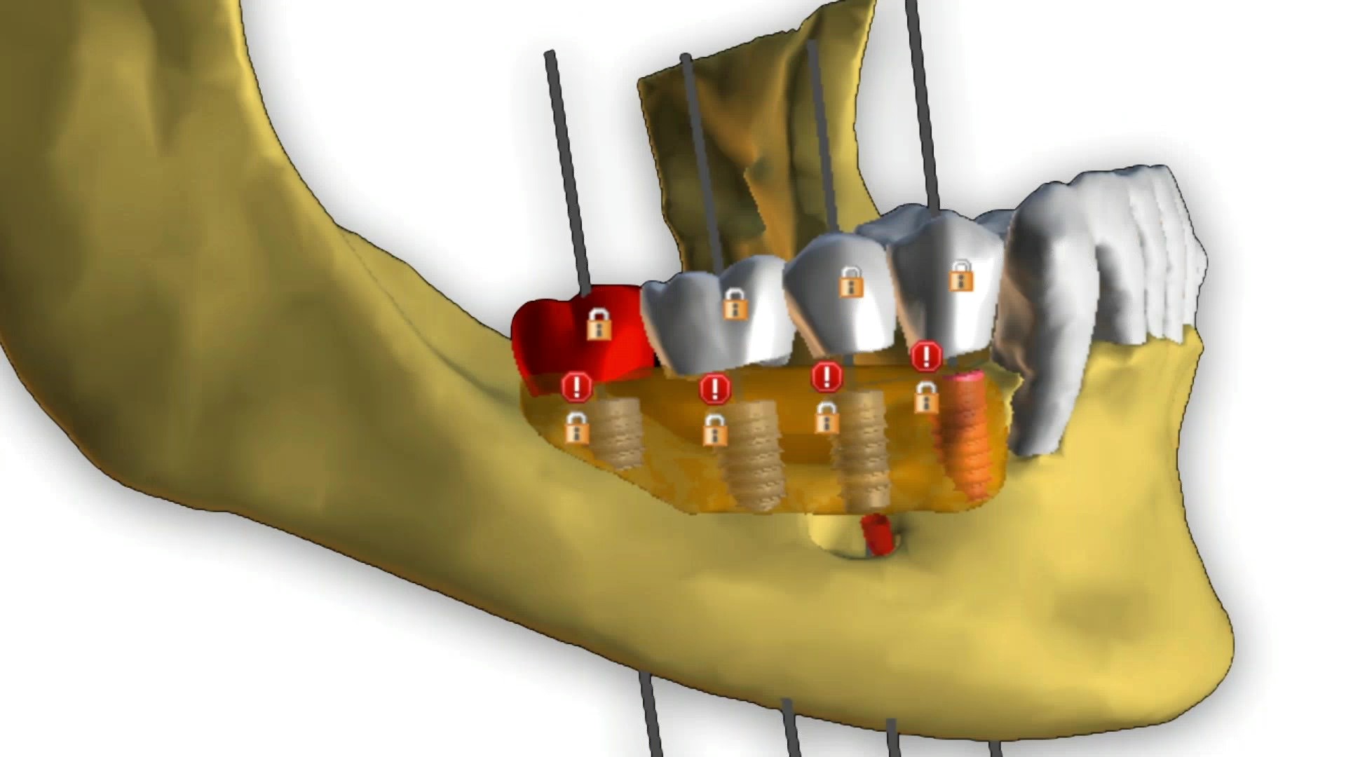 Dental Implant Cinco Ranch