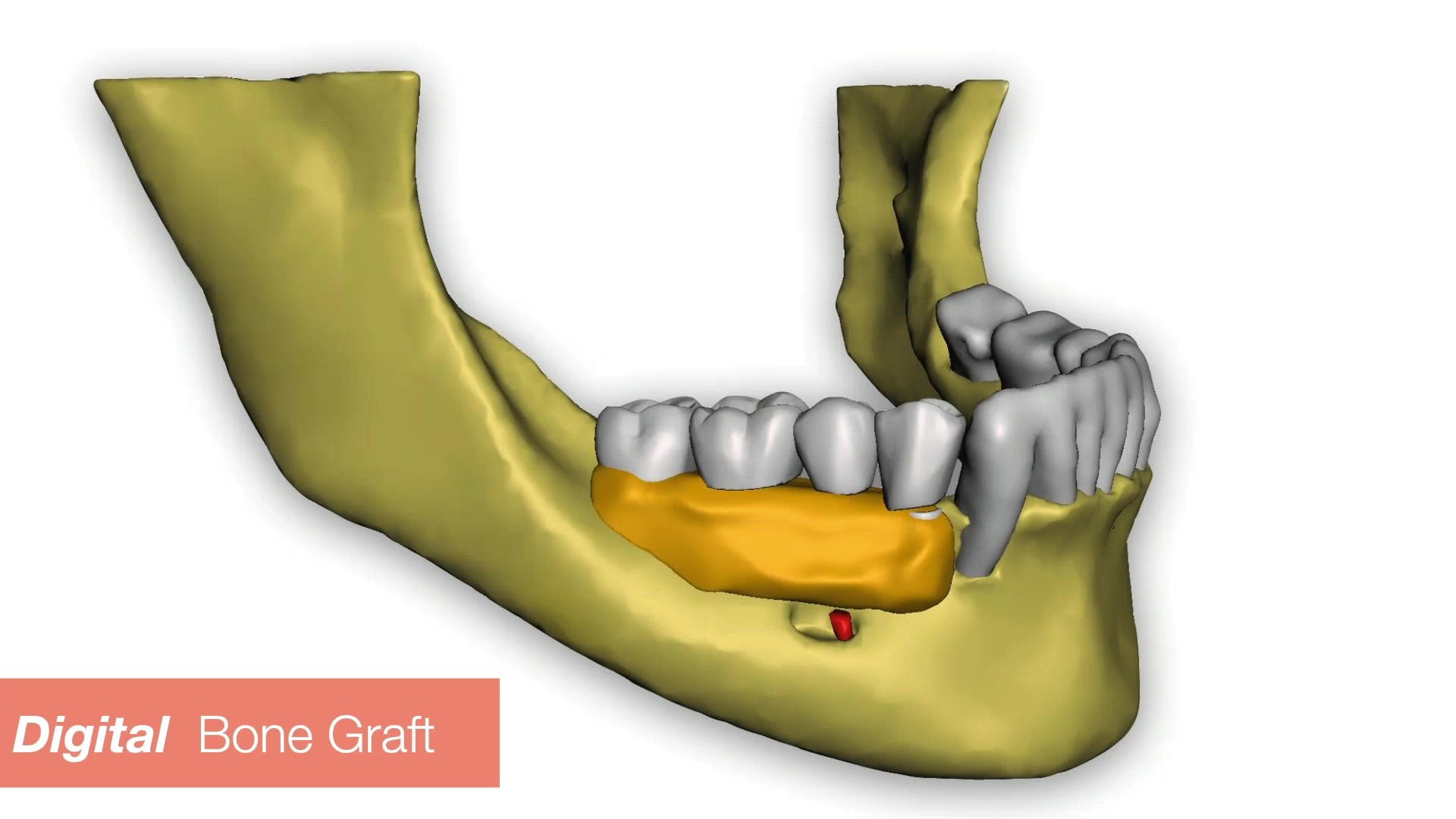 Dental Implant Cinco Ranch