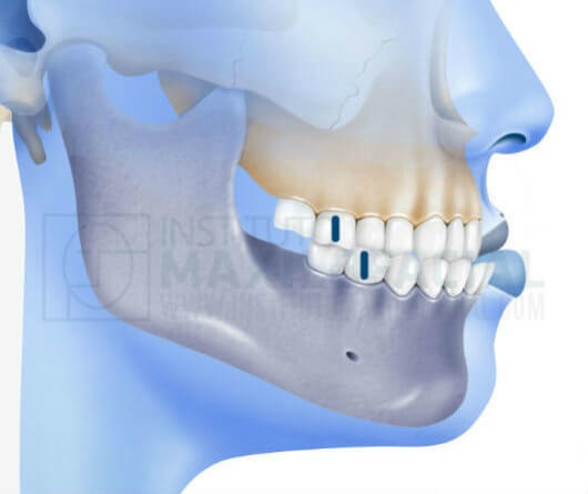 Class III- Pearland Orthodontics
