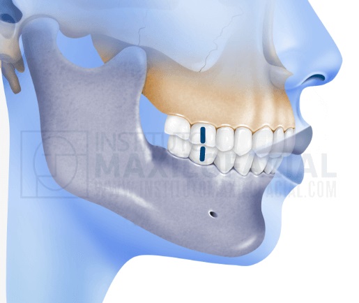 Class I -Pearland Orthodontics