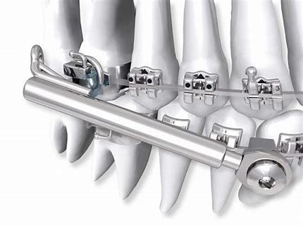 Pearland Orthodontic Treatment 