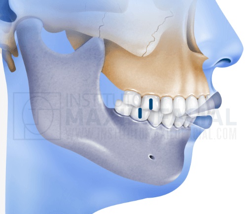 Class II- Pearland Orthodontics