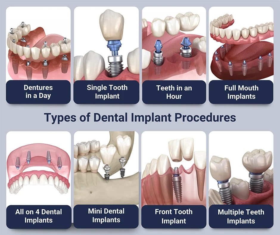 Cinco Ranch Dental Implant